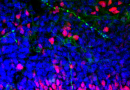 Sla, sicuri i trapianti di cellule staminali cerebrali